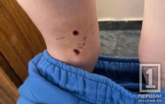 Просто йшов зі школи: у Саксаганському районі собака вкусила дитину