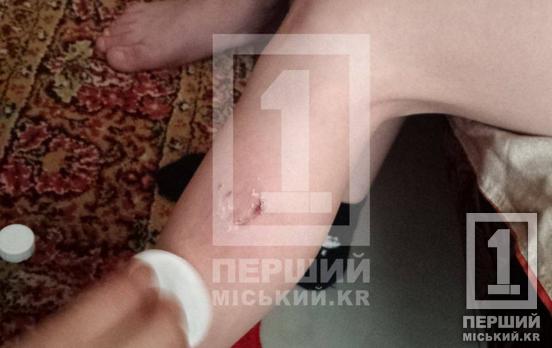 Дорога до школи завела на лікарняний: на Даманському зграя безпритульних собак напала на хлопчика