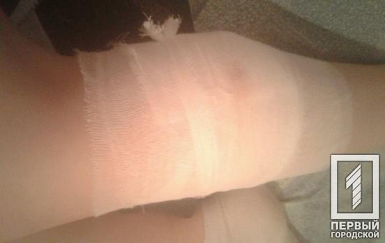 В Кривом Роге уличная собака укусила школьницу за ногу, - соцсети