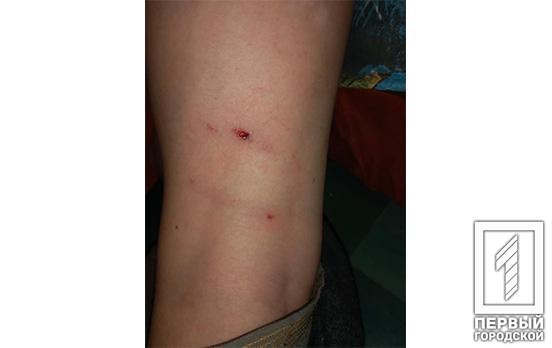 В Кривом Роге дворовые собаки покусали ребёнка, – соцсети